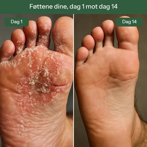 Cyntra™ Såpe mot Sopp
