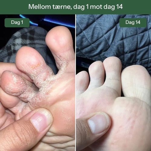 Cyntra™ Såpe mot Sopp